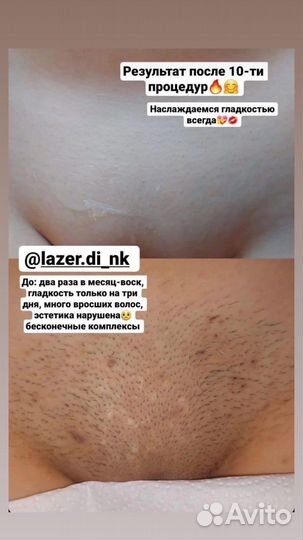 Лазерная эпиляци, холодная плазма, массаж