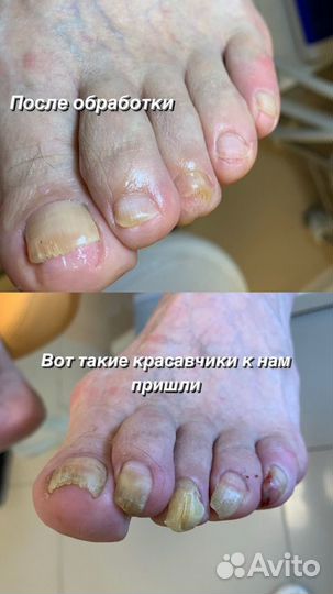 Медицинский педикюр