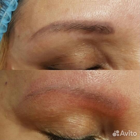 Удаление перманентного макияжа / татуажа