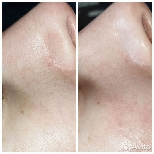 Ультразвуковая чистка лица