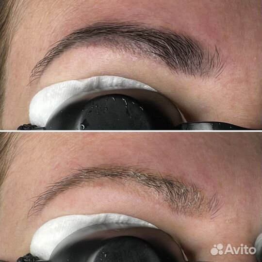 Лазерное удаление татуажа/тату