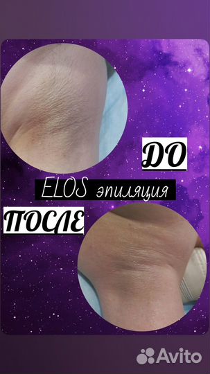 Элос эпиляция