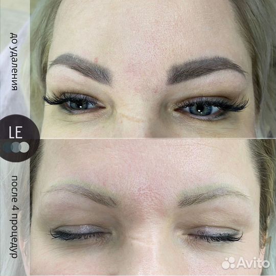 Удаление татуажа/тату на пикосекундном лазере