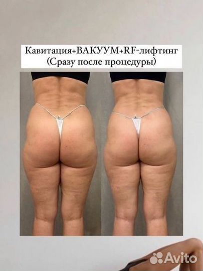 Аппаратный массаж