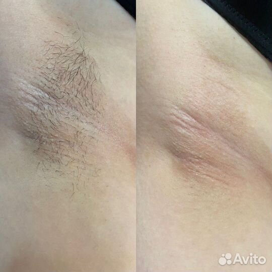 Лазерная эпиляция