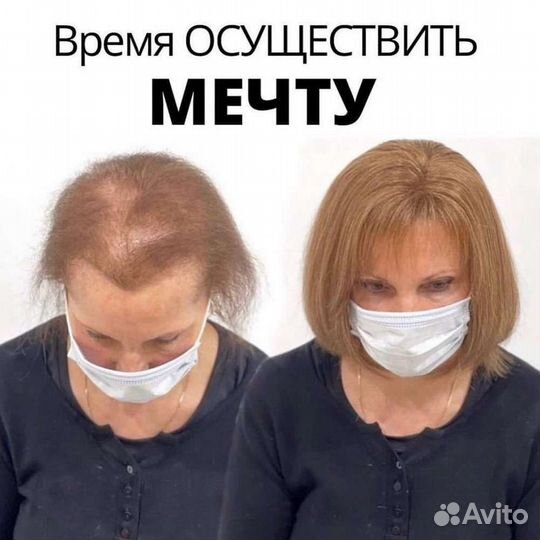 Система замещение для волос