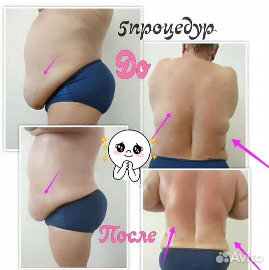 Массаж Тела(Коррекция Фигуры) Лечим Спину(Горбы)