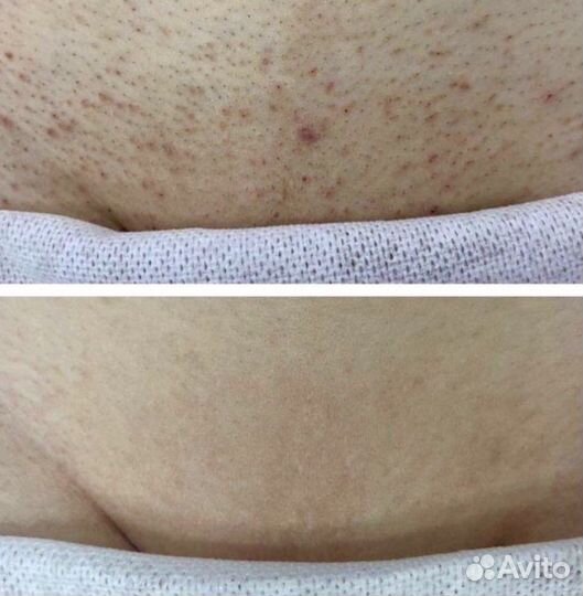 Лазерная диодная эпиляция