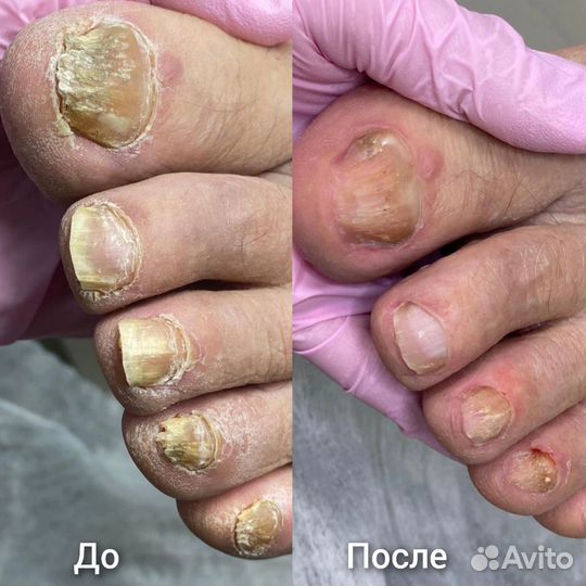 Подолог Педикюр Вросший ноготь Онихолизис