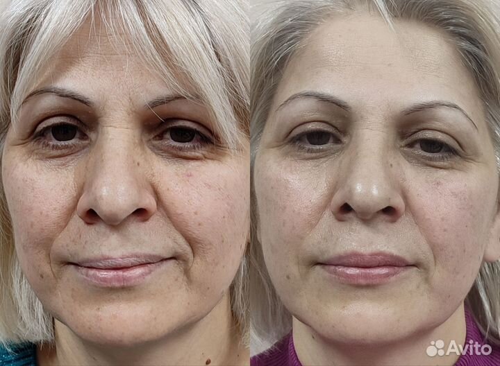 Массажи лица