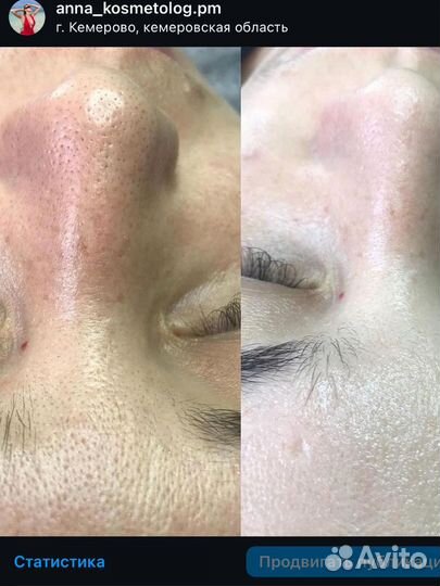 Чистка лица