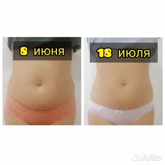 Криолиполиз / Коррекция фигуры