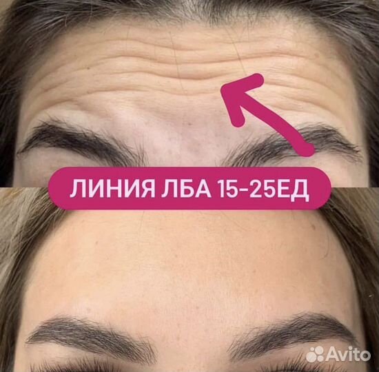 Модель на ботокс