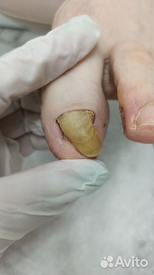 Подолог / Лечебный педикюр