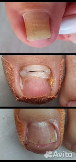 Подолог, вросший ноготь, сложный педикюр