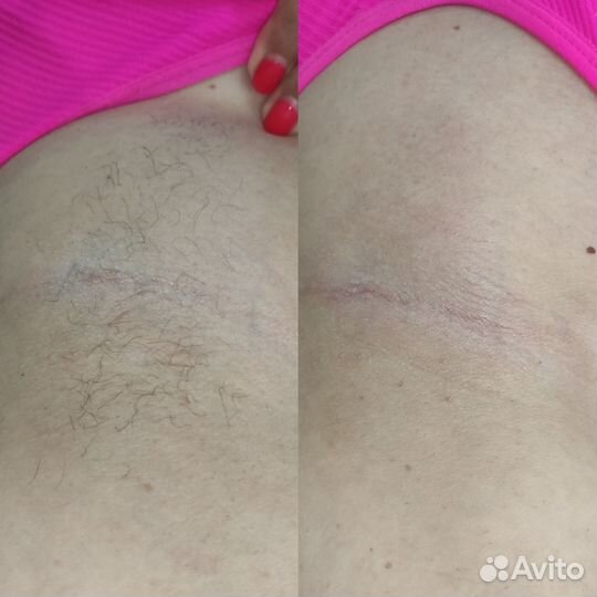 Депиляция воском и шугаринг