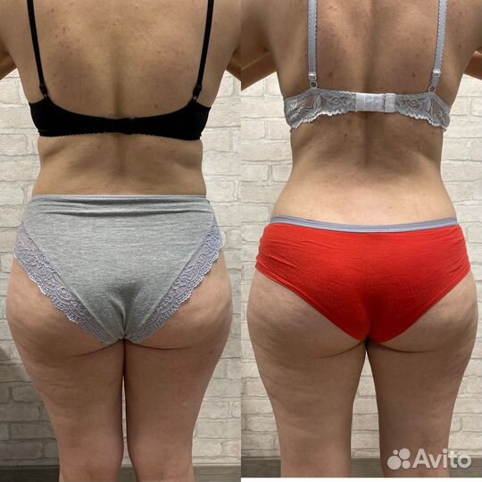 LPG лпж массаж в Красноярске