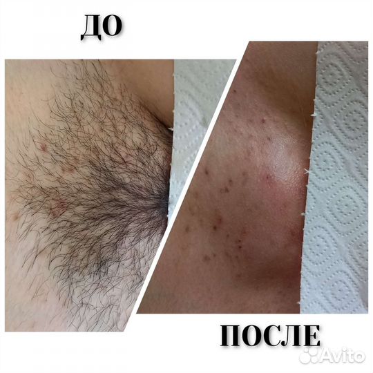 Депиляция воск/сахар