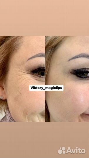 Ботокс для лица