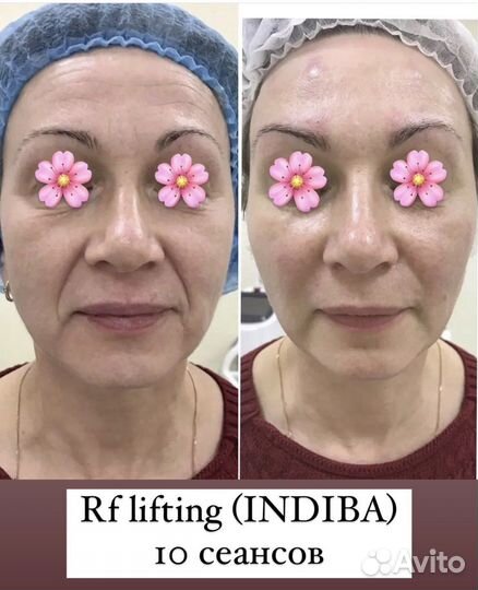Нужна модель RF lifting (Indiba) массаж лица