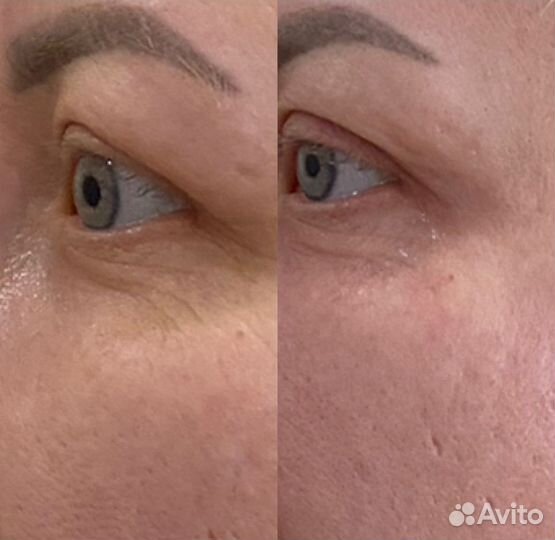 Холодная плазма