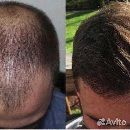 Пересадка волос Гарантия/ Качество/ Результат