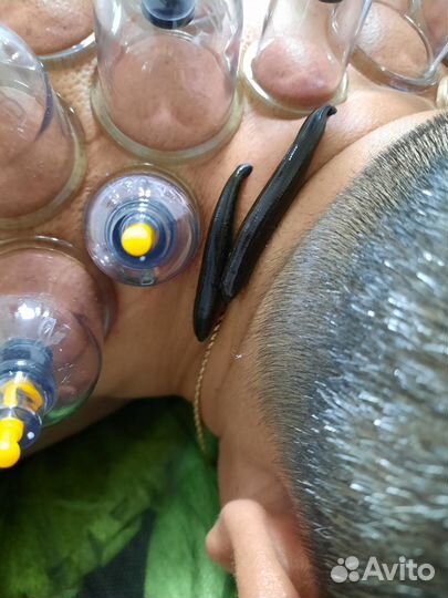 Купон на сеанс гирудотерапии