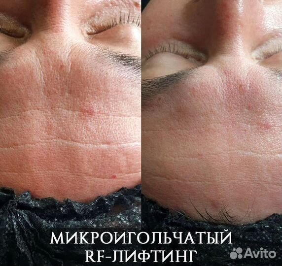 Микроигольчатый RF лифтинг лица