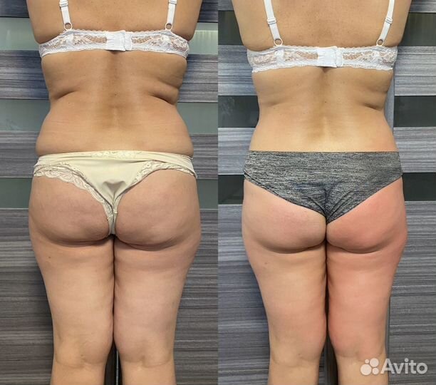 Антицеллюлитный массаж