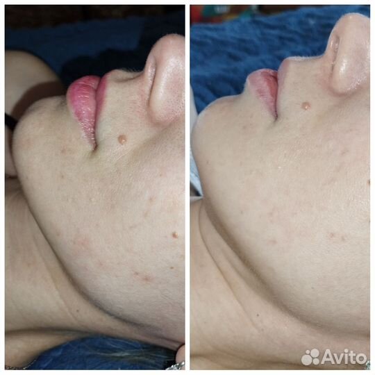 Ультразвуковая чистка лица