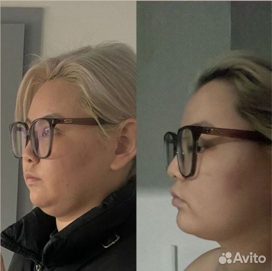 Супер омоложение и подтяжку лица без уколов