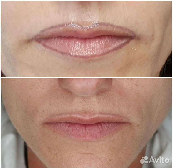 Удаление тату/татуажа