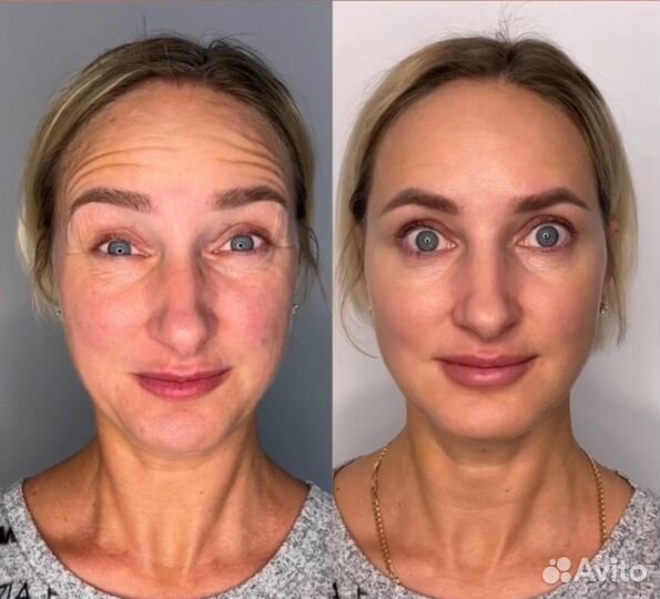 FullFace Botox