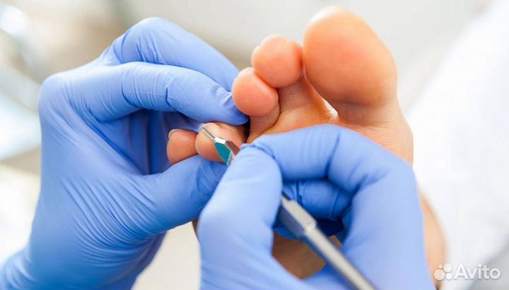 Подолог (медицинский педикюр, вросший ноготь)