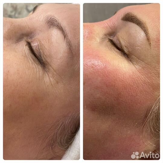 УЗ чистка,Кавитация, вакуумный массаж, рф-лифтинг