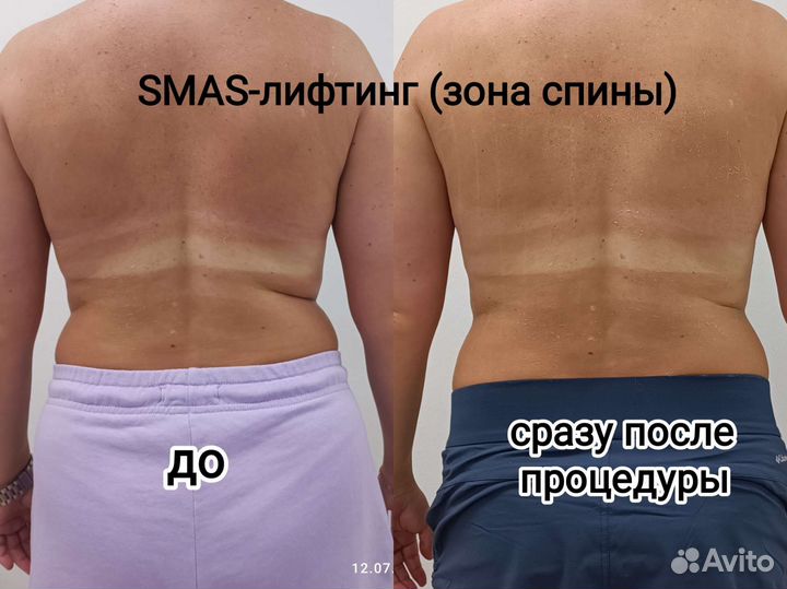 Кавитация, смас-лифтинг, RF- лифтинг, биофотон