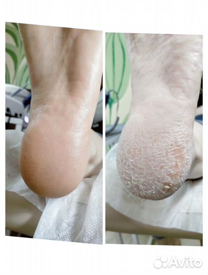 Педикюр и маникюр, титановые ногти