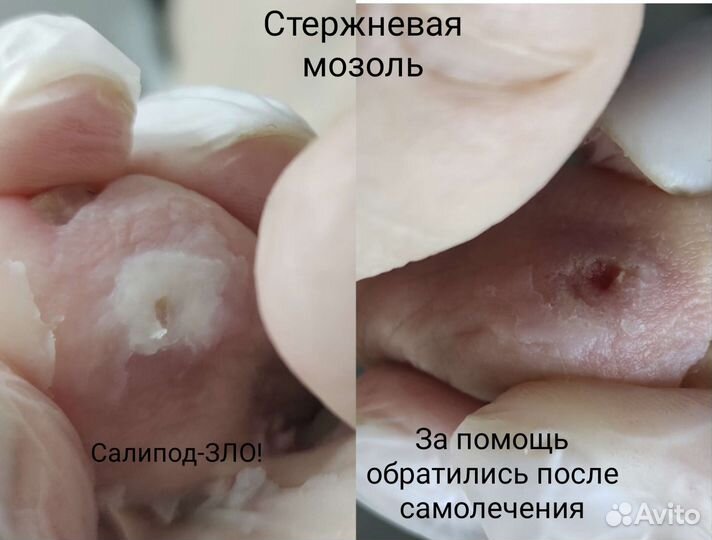 Подология. Педикюр. Медицинский педикюр