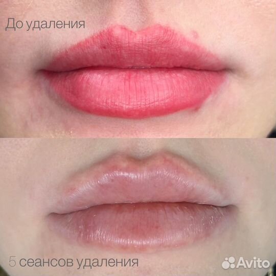 Удаление татуажа и тату