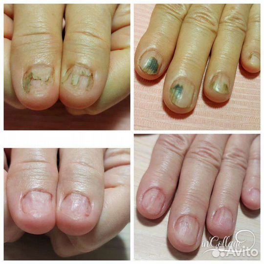 Подолог. Медицинский педикюр