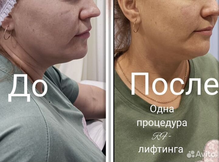 LPG массаж Pascal