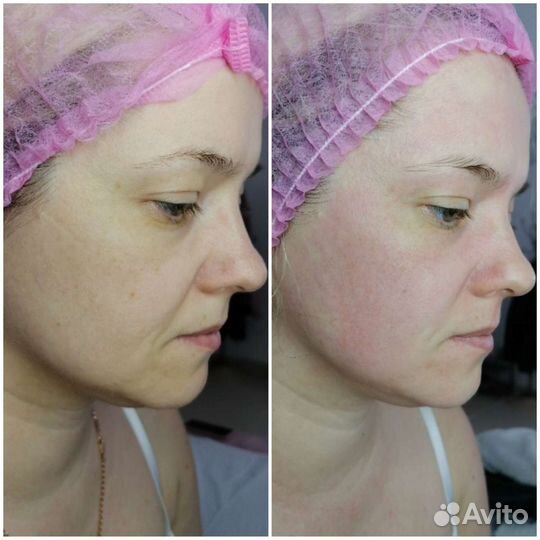 Flaxlift для омоложения лица