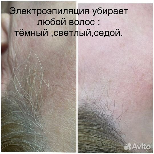 Электроэпиляция Apilus