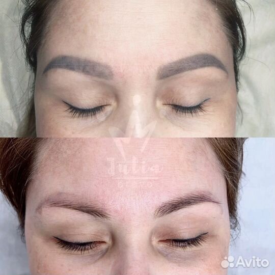 Лазерное удаление тату и татуажа