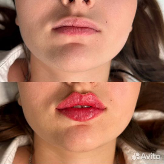 Увеличение губ, контурная пластика. Высший уровень