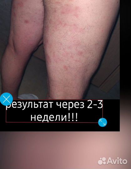 Мазь от проклятого псориаза 200гр