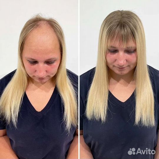 Система замещение для волос