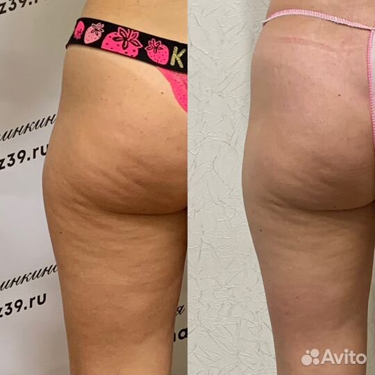 Оздоровительный массаж Балтрайон