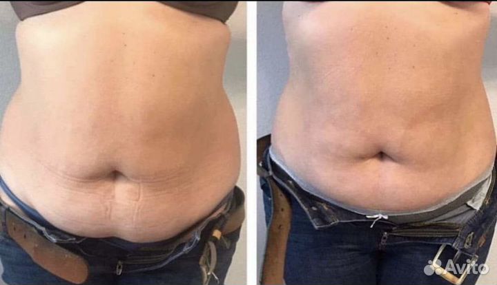 SMAS лифтинг подольск