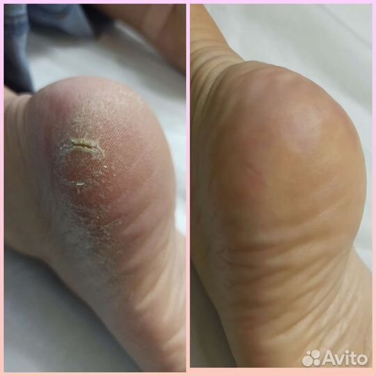 Подология, педикюр